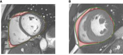 Associations of aortic stiffness and intra-aortic flow parameters with epicardial adipose tissue in patients with type-2 diabetes